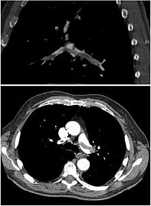 CT scan of pulmonary embolism